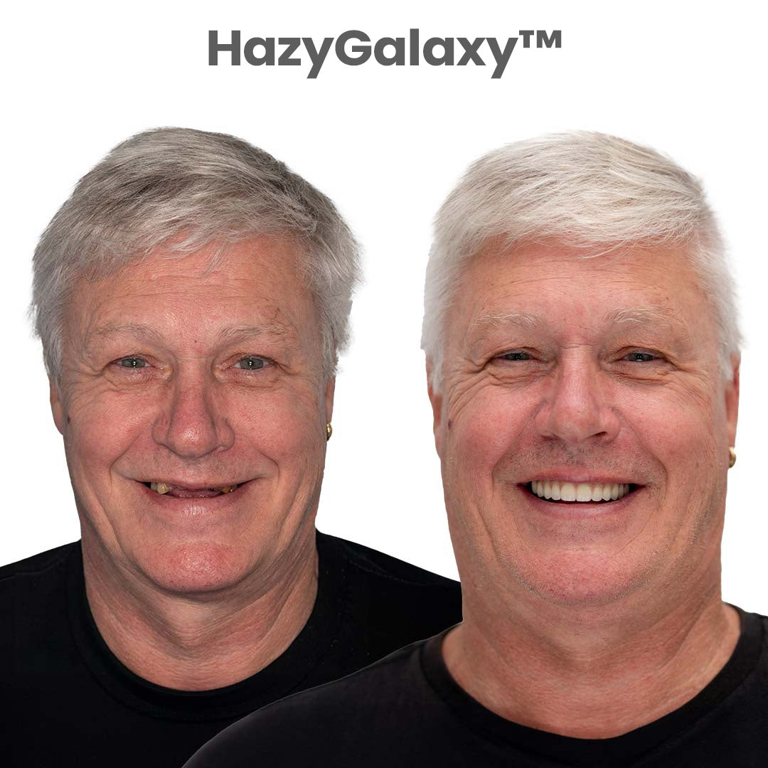 --🦷 HazyGalaxy™ Custom-Fit Dentures ⏰ ENDS TODAY 70% OFF | Smile with Confidence