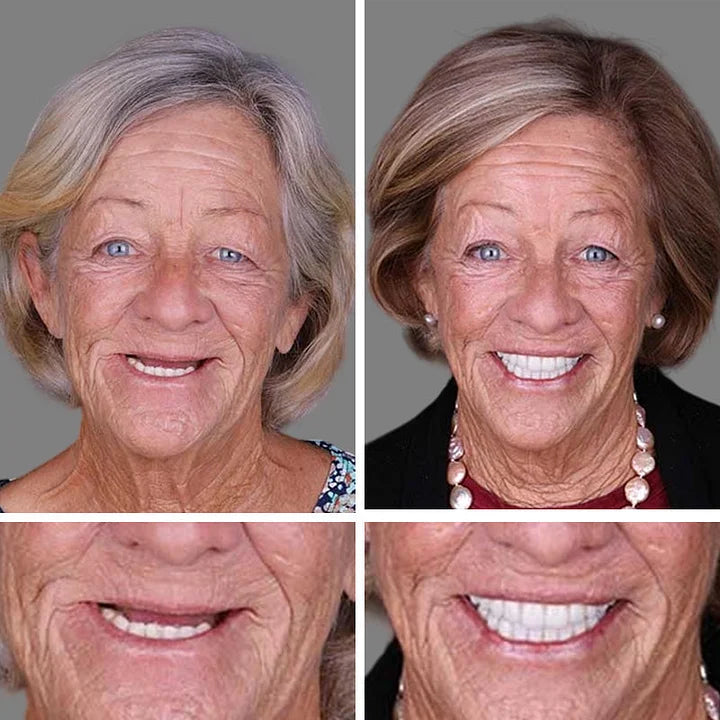 🔥Ends Today: 75% OFF! ⏰DarkFairy™ Medical Full Denture with Strong Suctiond Custom-Fit Full Functional Dentures🦷