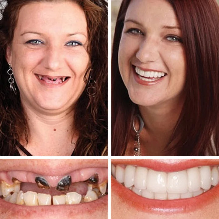 🌟Ends Today: 70% OFF! ⏰DarkFairy™ Medical Full Denture with Strong Suctiond🦷