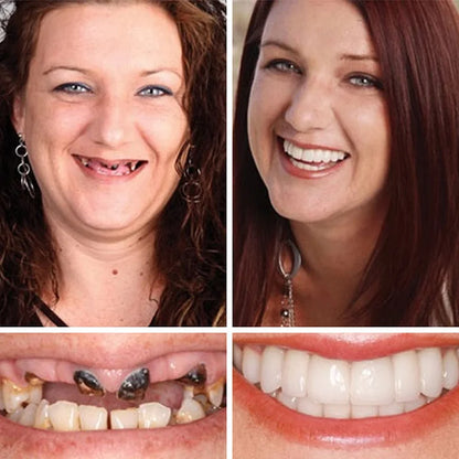 🌟Ends Today: 70% OFF! ⏰DarkFairy™ Medical Full Denture with Strong Suctiond🦷
