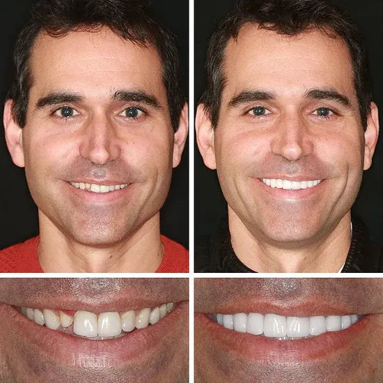 🏆Ends Today: 50% OFF!  🏆2026 Bestselling Product🦷 Fit for a Fresh Smile, Say Goodbye to Wearing Discomfort!🌎
