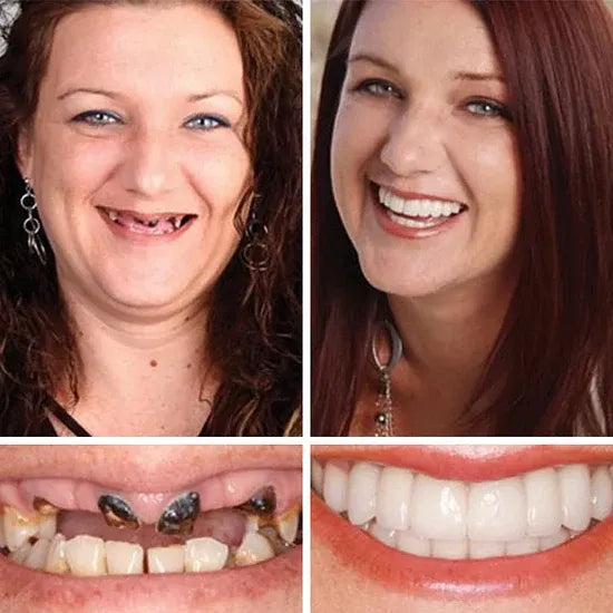 🏆Ends Today: 50% OFF!  🏆2026 Bestselling Product🦷 Fit for a Fresh Smile, Say Goodbye to Wearing Discomfort!🌎