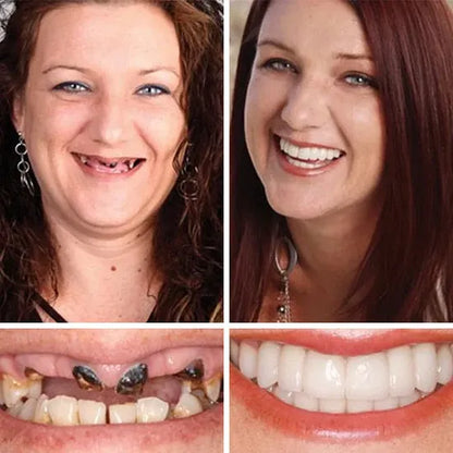 🏆Ends Today: 50% OFF!  🏆2026 Bestselling Product🦷 Fit for a Fresh Smile, Say Goodbye to Wearing Discomfort!🌎