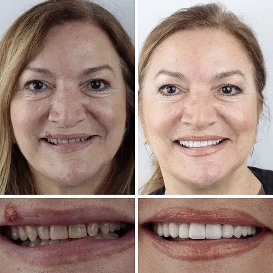 🏆Ends Today: 50% OFF!  🏆2026 Bestselling Product🦷 Fit for a Fresh Smile, Say Goodbye to Wearing Discomfort!🌎